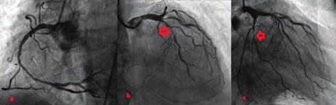 In LAD TIMI 3 flow, in cicumflex artery TİMİ flow were seen. And final image was satisfactory (Figure 6). The patient was followed up without any complication for three days in intensive care unit.