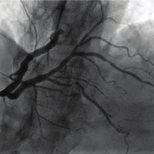 Discussion: The incidence of cardiac perforation during angioplasty is 0.%, but can be as high as 3% when devices such as an atherotome or laser are used.