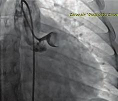 Girişimsel kardiyoloji / Koroner Girişimsel kardiyoloji / Koroner OPS-07 A giant aneurysm of the distal left main coronary artery in a patient presenting with acute anterior myocardial infarction