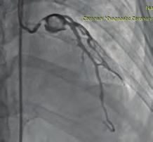 Ankara Introduction: A coronary artery aneurysm (CAA) is defined as a.5-fold or more fusiform or sagittal enlargement of the normal coronary artery diameter.