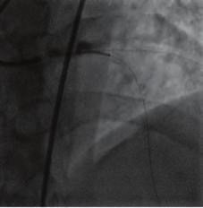 This case report presents a giant aneurysm of the LMCA observed in the coronary angiography of a 37-year-old female patient who was brought to emergency services due to cardiac arrest and whose