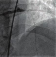 Case: A 37-year-old female patient, who had been followed up with SLE diagnosis, was brought to the emergency services due to cardiac arrest that developed following chest pain.