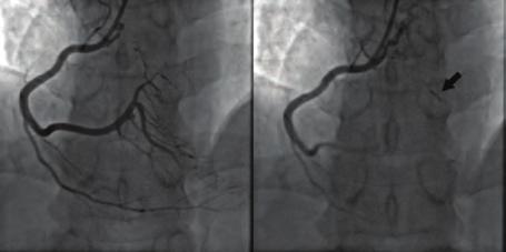 Despite there was no evidence of reversible perfusion defects myocardial perfusion SPECT imaging, due to the persisting anginal complaints in 43-year-old man, we performed coronary angiography.