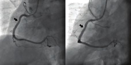 Conclusion: Post-CABG anginal complaints may be related to a LIMA-PA fistula, and with careful evaluation it can be diagnosed by selective angiography. Figure. Initial ECG. Figure and 3.