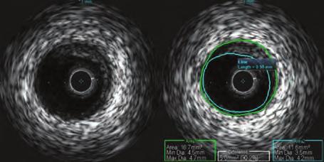 Figure 4 and 5. After thrombus aspiration. Figure 6 and 7. Control coronary angiography. Figure 8 and 9. IVUS images. 34.