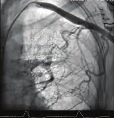 Cardiology, Adana Numune Training and Research Hospital, Adana A 64-year-old female patient who underwent hemodialysis with a right upper extremity arteriovenous fistula (AVf) due to end-stage renal