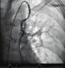 Her physical examination was revealed with right arm swelling, cyanosis and also her chest exam showed visible veins in the right upper chest (Figure ).