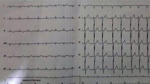 takıldı işlem başarı ile sonuçlandı. Şekil. Şekil 3. OPS-036 Şekil. Graft stent önçesi görüntü popliteal arter-ven. OPS-035 Şekil. Graft stent sonrası görüntü popliteal arter-ven.