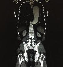Girişimsel kardiyoloji / Karotis ve periferik vasküler Girişimsel kardiyoloji / Karotis ve periferik vasküler OPS-037 Tip 3 aort diseksiyonu vakasının endovasküler girişim ile tedavisi Mustafa Fehmi