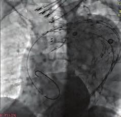 Bu bilgi ışığında hastaya TEVAR (thoracic endovascular aneurysm repair) işlemi planlandı. Torasik aortadaki belirgin tortiyozite nedeniyle dört adet sert tel kullanıldı.