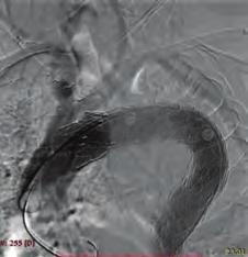 Hataya eş zamanlı eritrosit süspansiyonu replasmanı yapıldı. Kontrol görüntülerde arkus aorta dallarında yeterli akım olduğu teyit edilerek işlem sonlandırıldı (Şekil 4-5).