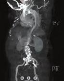 5 and 0.8, respectively. The right limbs angiography showed totally occlusion of veingraft bypass from SFA to popliteal artery and in-stent occlusions of SFA.