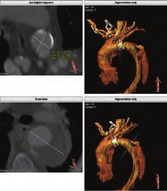 035-inch stiffness wire with microcatheter and noticed that wire passing through the subintimal space after dilated and crushed the total occlusion part of previously implanted self expanding stent