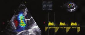 Ekokardiyografi parasternal uzun eksende aort ve mitral kapaklarda ekojenite artışı ve hafif orta derece aort kapak yetmezliği dikkati çekti (Şekil ).
