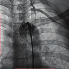 ventricle ejection fraction. D-dimer and NT-proBNP were increased >4,33,3 mcg/l FEU and 536 pg/ml respectively.