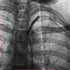 pulmonary artery. Transthorasic echocardiography showed a normalized systolic pulmonary artery pressure and recovery of tricuspid regurgitaiton.