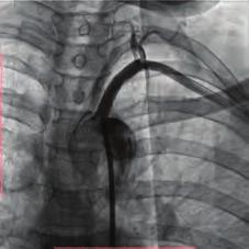 We snared the wire and externalized it from the femoral artery. Figure 4. We did 5.0x40 mm balloon predilatation. Figure. Contrast enhanced tomography: massive thrombus formation in the right pulmonary artery.