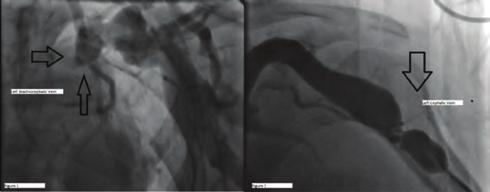 Ekos catheter introduced into the right pulmonary artery delivering ultrasound accelarated thrombolytics. OPS-043 Figure 4.