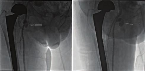 surgically inserted 3 years ago. Computed tomography showed the port s catheter tip in the superior caval vein (SVC) and lying through the right atrium (Fig. a).
