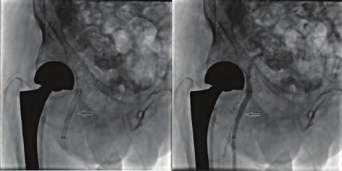 After insertion of an 8 F venous sheet to the right femoral vein, a snare catheter (ONE Snare, USA) diameter with 5 mm was inserted in to 8F right judkins guiding catheter and advanced to the SVC.