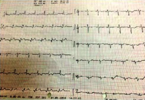 Girişimsel kardiyoloji / Karotis ve periferik vasküler Girişimsel kardiyoloji / Karotis ve periferik vasküler Sonuç: STEMI yönetiminde primer PKG planlanan hastalarda katater labaratuvarında bazı