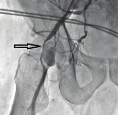 Fizik muayenede dorsalis pedis ve tibialis posterior arter nabızlarının zayıf olduğu saptandı. Hastanın alınan anamnezinde 0 gün önce dış merkezde sağ femoral arterden anjiografi hikayesi mevcuttu.