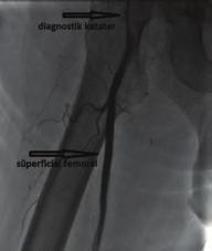 Crossover yapılarak sağ ana iliak arterden itibaren görüntüleme yapıldı. Sağ ana femoral arter ostium hizasında lümeni %90 daraltan psödoanevrizma izlendi (Şekil ). Bunun üzerine 0.