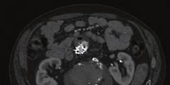 Conventional venography was performed afterwards which demonstrated total occlusion of right VCS extending into distal axillary vein.