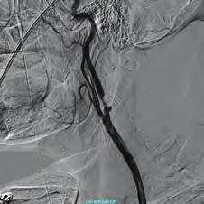 Şekil 5. Karotis arterde komplike plak. Şekil 6. Karotis pre-dilatasyonu. Figure 3. The final image of subclavian artery. OPS-057 Şekil 7. Final sonuç.