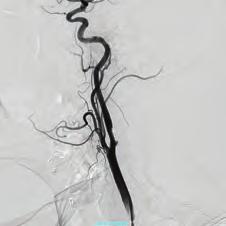The left internal mammary artery (LIMA) which a branch of subclavian artery (SA) is the first conduit option for grafting to the left anterior descending artery (LAD) due to commonly provides