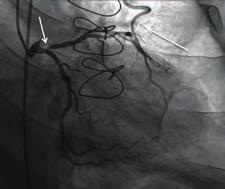 Described is a case of 44-year-old male patient that had a history of CABG three months ago and admitted to emergency department with severe chest pain.