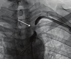 percutaneous SA intervention Case Report: A 44-year-old patient was presented to the emergency department with severe and typical chest pain lasting two hours.