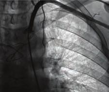 The patient had a history of diabetes mellitus, hypertension and CABG three months ago, involving saphenous vein grafts from the aorta to the right coronary artery, obtuse marginal and LIMA graft to