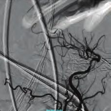 Saphenous vein graft of circumflex artery was found as occluded, whereas right coronary artery s graft was patent.