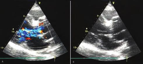 , Eskişehir State Hospital, Eskişehir 3 Department of Cardiology, Çanakkale Onsekiz Mart University Faculty of Medicine, Çanakkale This case illustrates the follow-up of a 57-year-old female with