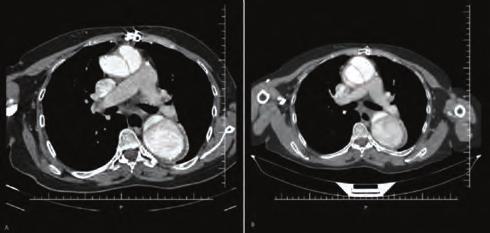 Aortic valve was repaired and 6 mm Dacron greft was used in ascending aorta and aortic arch.