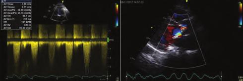 Six months ago the patient was diagnosed with atrial fibrilation. In transthoracic echocardiography, ejection fraction was within normal limits and moderate aortic regurgitation was seen.