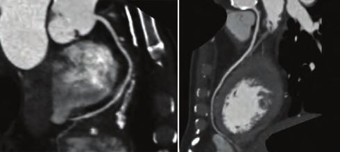 False lumen was trombosed from the beginning of the dissected segment to abdominal aorta but contrast was seen on the false lumen of the abdominal aorta.