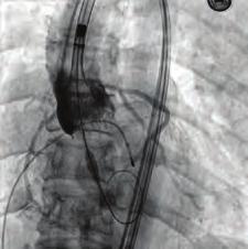 In type III LAD portion of the artery in interventricular posterior group known as posterior recurrent interventricular artery may entirely substitute PDA.