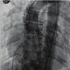 Additionally, understanding the culprit lesion allows the cardiologist for prospecting post-mi complications like conduction disturbances or mechanical complications.