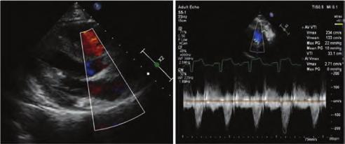 Inferior and anterior ST segment elevation due to LAD lesion imply Type 3 LAD. In our case we described the unusual form of wrapped LAD. Figure 4. Multislice CT.