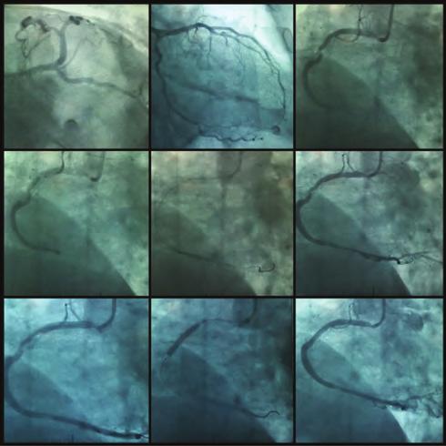 Despite conventional non selective angiography excluded any critical obstructive coronary artery disease, a coronary computed tomography angioghrapy was planned for further evaluation of coronary