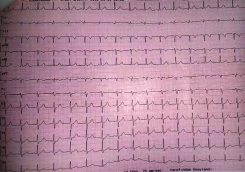 Girişimsel kardiyoloji / Koroner Girişimsel kardiyoloji / Kapak ve yapısal kalp hastalığı OPS-064 Şekil 3. PTCA sonrası EKG de ST segment elevasyonlarının düzelmesi.