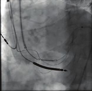 Girişimsel kardiyoloji / Kapak ve yapısal kalp hastalığı Girişimsel kardiyoloji / Koroner OPS-069 Implantation of CARILLON mitral contour system after cardiac resynchronisation therapy Bilge Duran