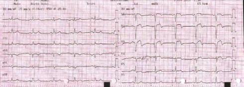 Although a concomitant functional mitral regurgitation (FMR) is often reduced by CRT, many patients need additional mitral valve repair.