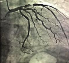 In this case report; we present a 58-year-old woman with dilated cardiomyopathy and FMR, who underwent a successful CRT implantation.