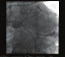 LAD-LİMA grefti açık ve yapılan aortografide safen greft görüntülenmedi. Tipik göğüs ağrısı olan hastanın diagonaldeki lezyona müdahale edilmesi planlandı.