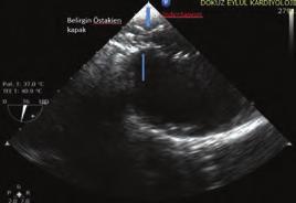 Tartışma: Aortografi By-pass lı hastalarda selektif olarak greftler görüntülenemediği takdirde rutin kullanılmaktadır.