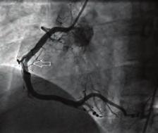 Şekil 8. Hastanın 6 ay önceki koroner anjiografi görüntüsü RCA. Kalp damar cerrahisi OPS-074 Treatment of a patient with electrical storm after coronary artery bypass grafting Şekil.
