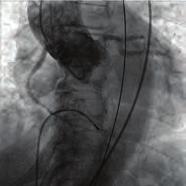 Girişimsel kardiyoloji / Kapak ve yapısal kalp hastalığı Girişimsel kardiyoloji / Kapak ve yapısal kalp hastalığı floppy wire was placed on to the left coronary cusp through the pigtail catheter.